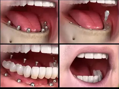  Full Mouth Rehabilitation