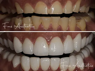 Full Mouth Smile Makeover