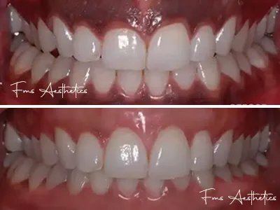 Gum Contouring & Reshaping