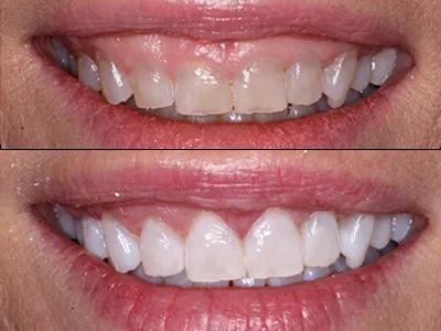   Gummy Smile Correction