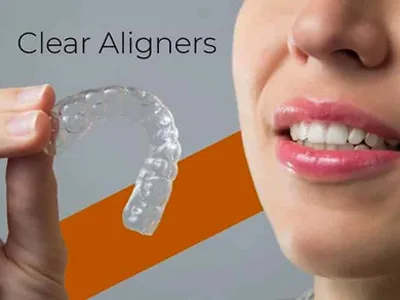    Invisalign & Clear Aligners