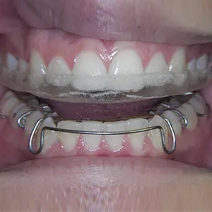 Orthodontic Treatment