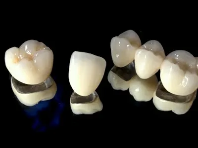    Porcelain Crowns