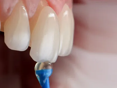 Porcelain Veneers & Dental Laminates