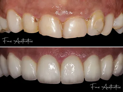 Smile Rejuvenation