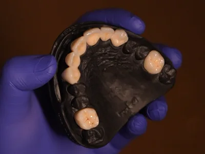 Zirconia & Metal-Free Crowns