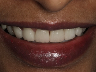  Smile Makeover Hyderabad