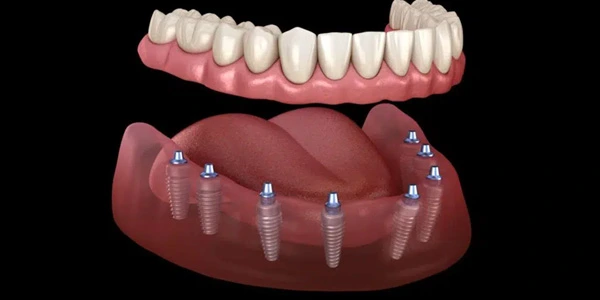 Conventional Full Arch Replacement with 6–8 Implants Per Jaw