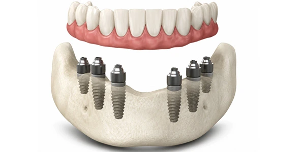 All-on-4 Plus® (All-on-6)