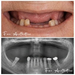 Bilateral zygoma Before