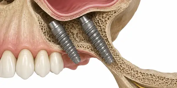 Bone loss extends past where tilting can reach