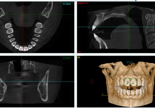 CBCT 3D Imaging