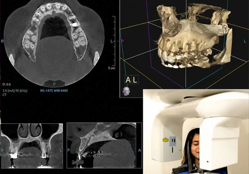 CBCT-Guided RCT