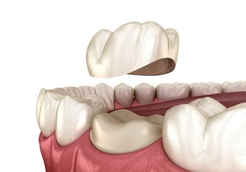 Crown Placement