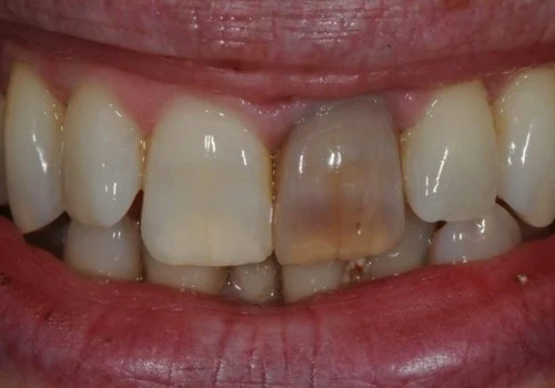 Darkened or Discoloured Tooth