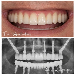 Extra-sinus protocol · Zero upper jaw bone after