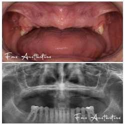 Extra-sinus protocol · Zero upper jaw bone before