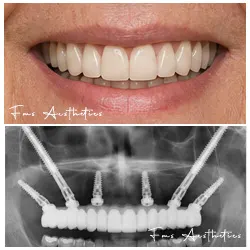 Failed Bone Graft Revision After