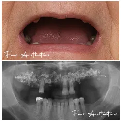 Failed Bone Graft Revision  Before