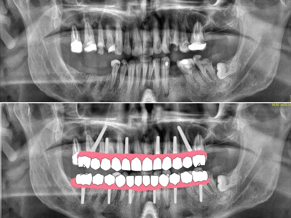Comprehensive CBCT Assessment - Key for Implant Placement Planning