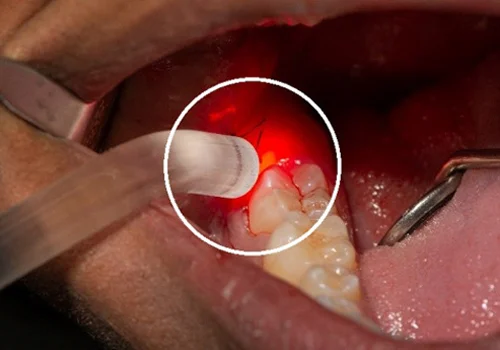 Laser Disinfection
