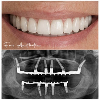 Bilateral zygoma USA Patient After 