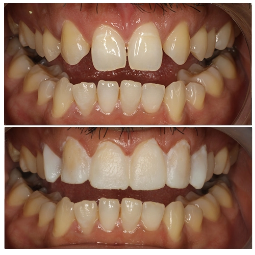 Mock Build-Up... Designing Your Perfect Smile before Treatment
