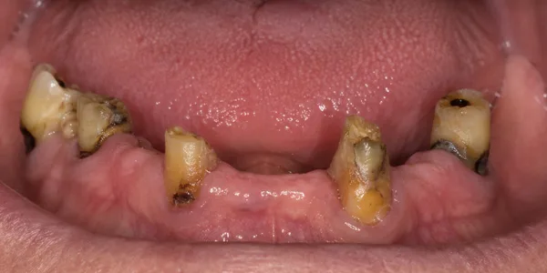 Most or all teeth are missing or failing in one jaw