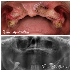 Zygoma + pterygoid · Jaw reconstruction Before