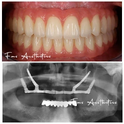 Zygoma + pterygoid · Jaw reconstruction After