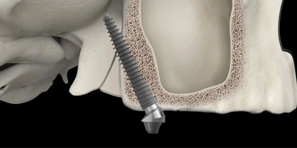 Pterygoid Implants