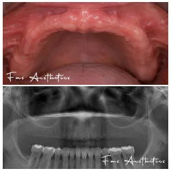 Quad Zygoma Before