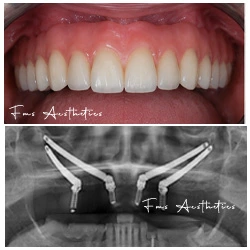 Quad Zygoma After