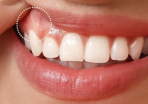 Swollen or Tender Gum