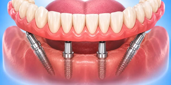 Tilting Two Implants