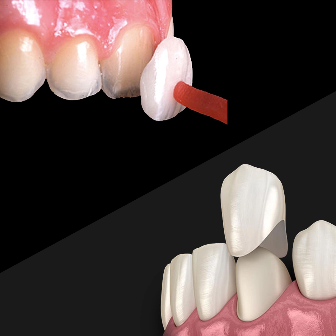 Dental Veneers over Dental Crowns