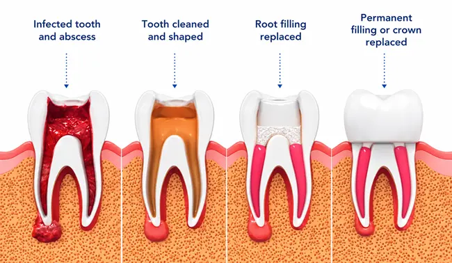 What is root canal treatment and how does it work