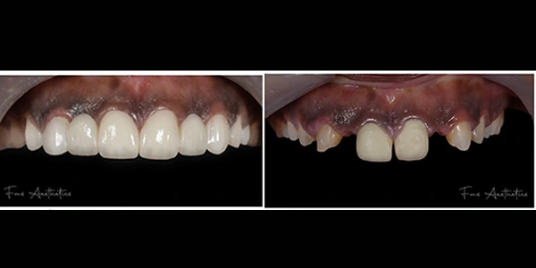 Zirconia in Hyderabad