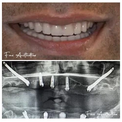Zygomatic After – zygomatic and pterygoid implants