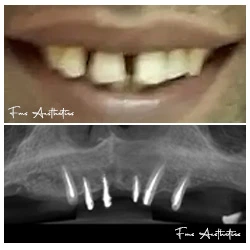  Zygomatic Before – severe bone loss