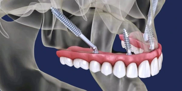 Zygomatic Implants
