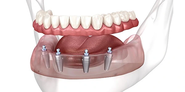 All-on-4® Dental Implants