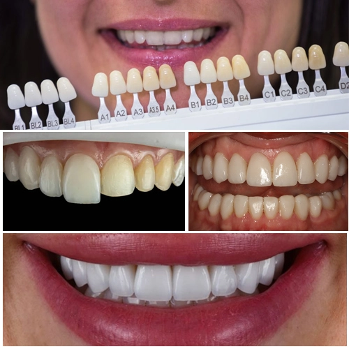 types of dental veneers