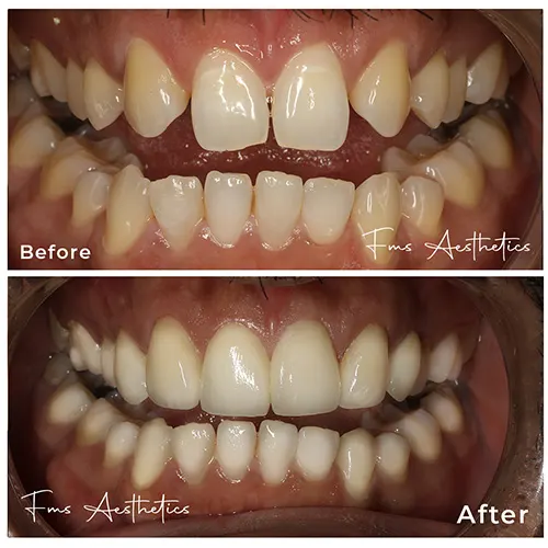 Mock Build-Up... Designing Your Perfect Smile before Treatment