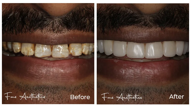 Same Day Smile with Composite Veneers