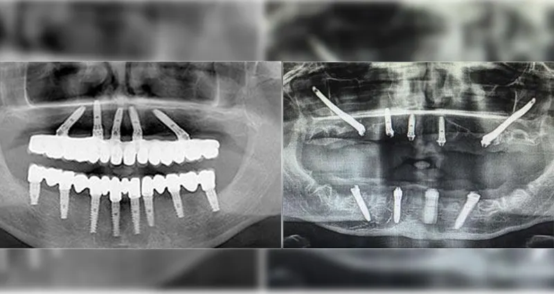 Advanced Dental Implant Treatment