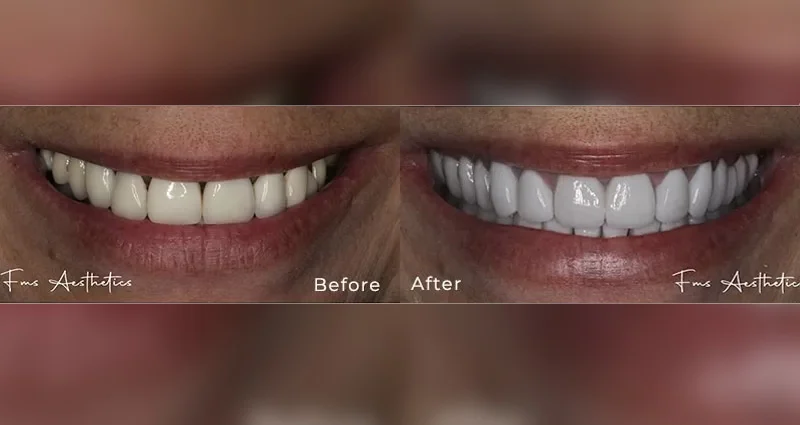 Porcelain Dental Veneers