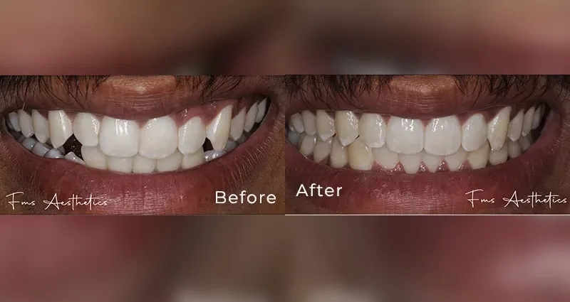 Cosmetic Dentistry Smile Makeover
