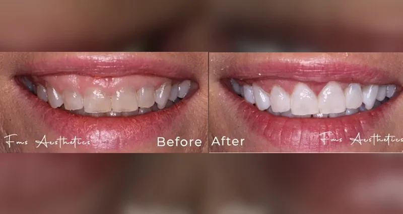 Smile Designing and Porcelain Dental Veneers