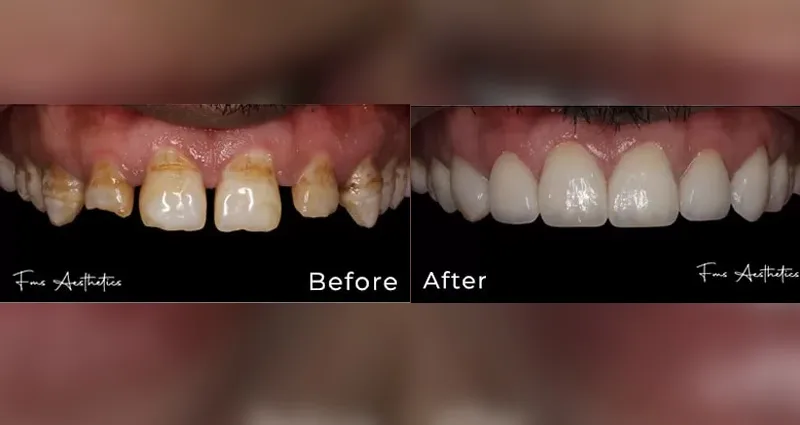 Hollywood Smile Makeover